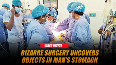 Bizarre Discovery: Doctors Retrieve Assorted Objects from Man's Stomach After 3-Hour Surgery